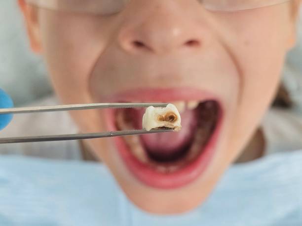 Best Broken or Chipped Tooth Repair in Venersborg, WA